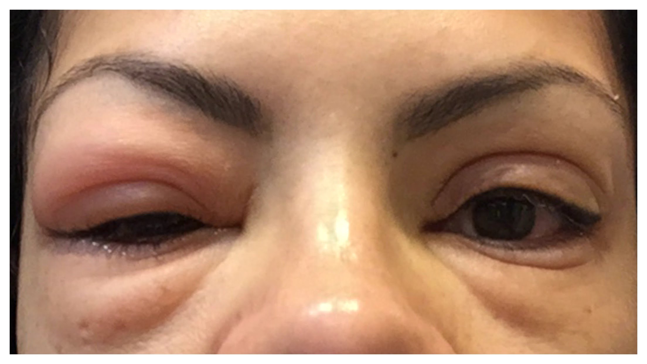 eyelashes false extensions infection effects side eyes swollen eyelids due eyelash remove makeup serious